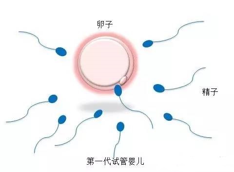 無精症
